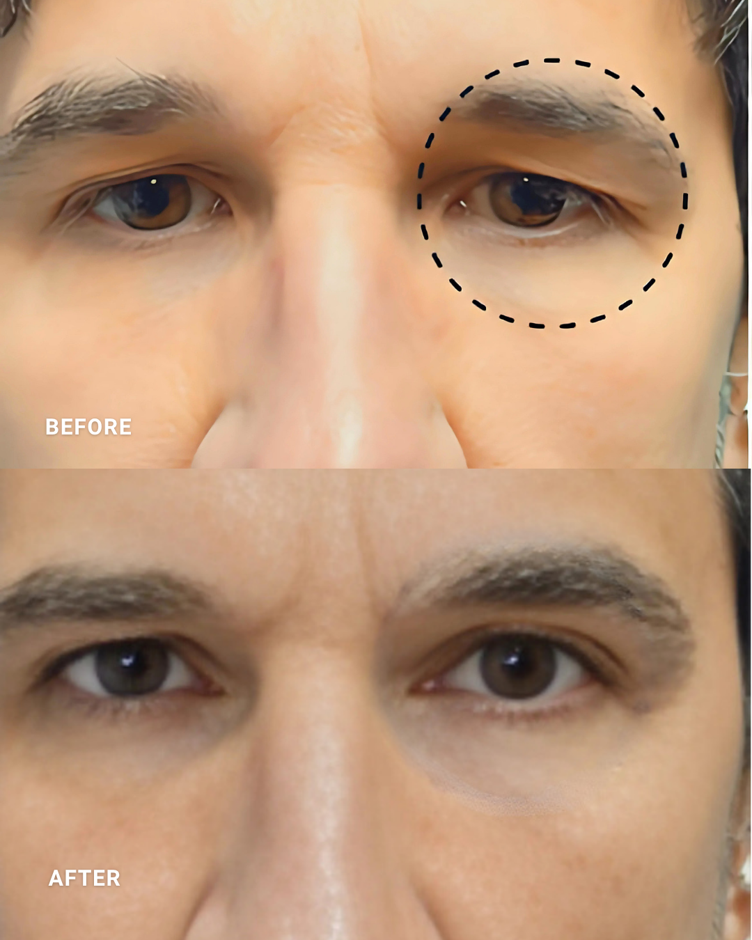 OcuLift | POST 1 TREATMENTS

*Individual results may vary.
