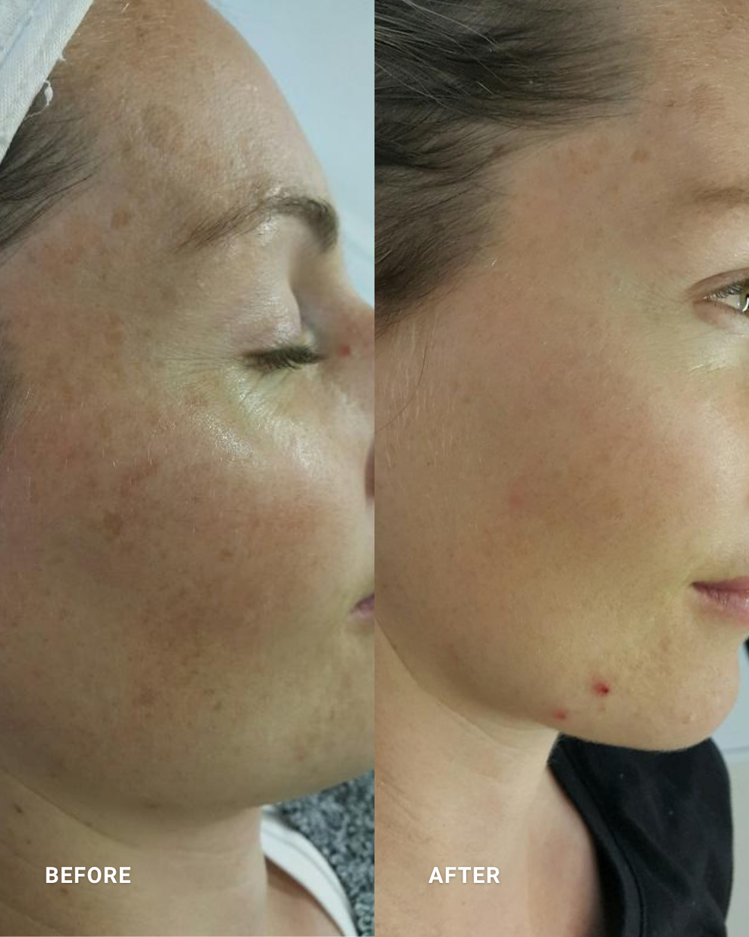 ELEO IPL:
Improves the appearance of sun damage and discoloration while promoting a brighter, more even skin tone.