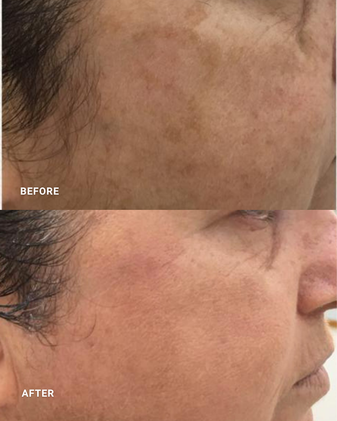 ELEO IPL:
Targets visible pigmentation and uneven skin tone for a clearer, more even-looking complexion.
