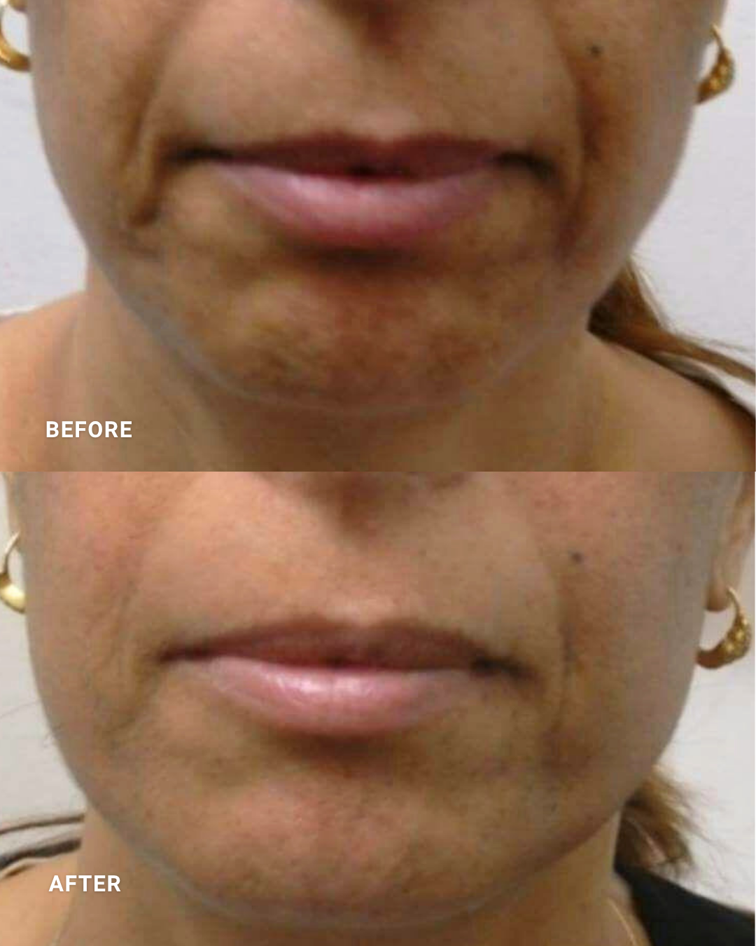 MICRO-FOCUSED RF :
Firms and tightens the lower face while improving the appearance of skin laxity and facial contours.