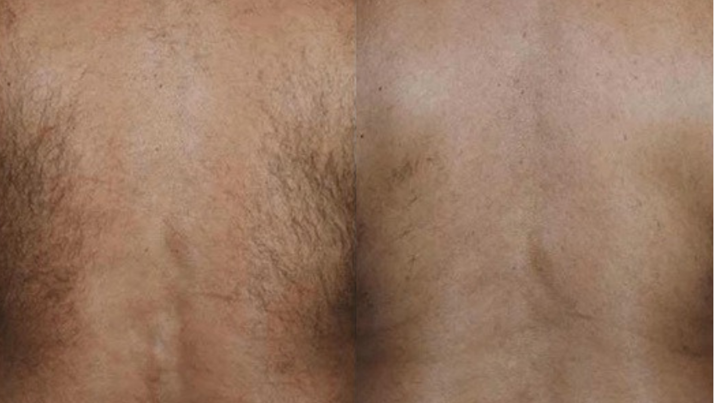 Close-up of human skin showing a before and after comparison of skin with reduced hair and improved texture.