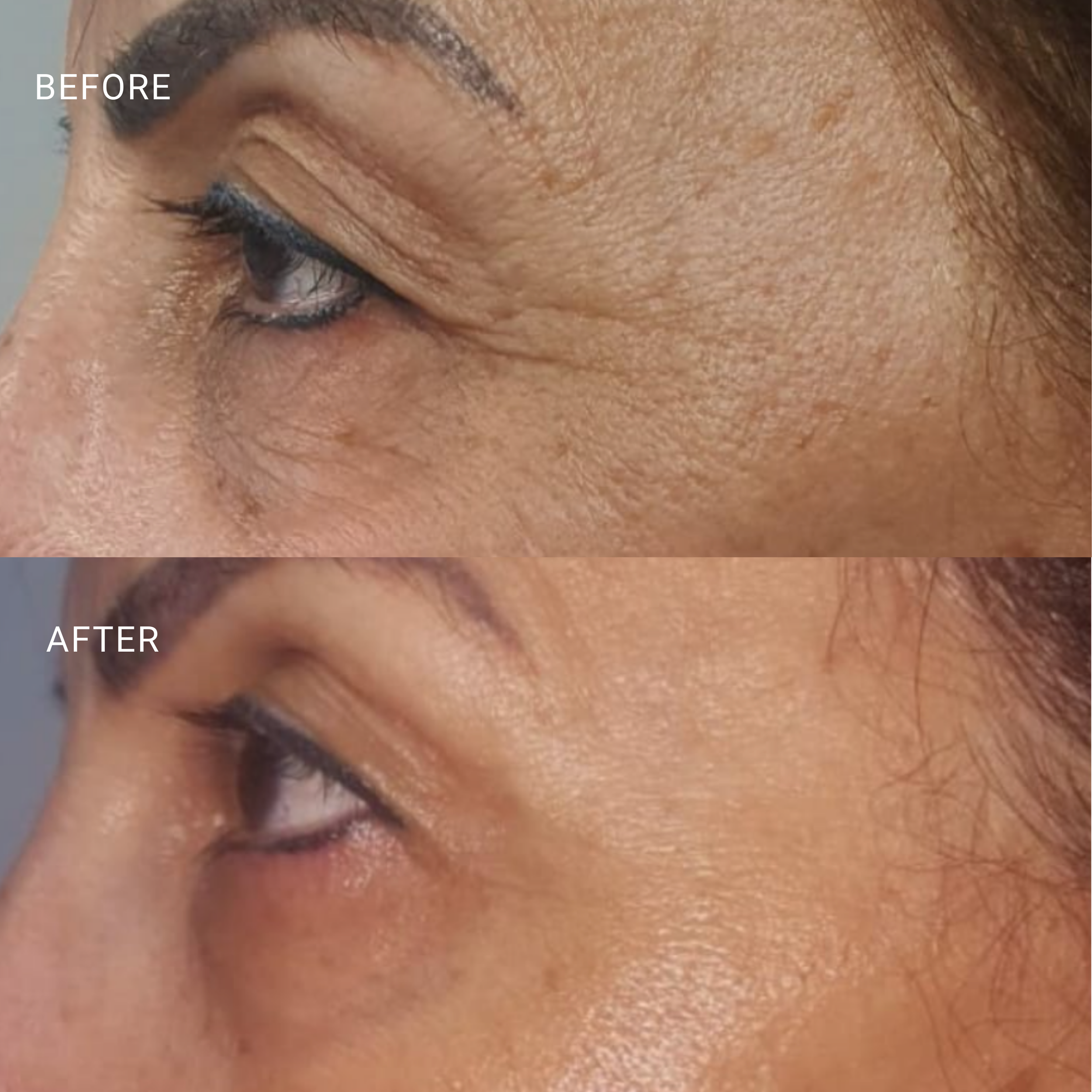 Smoother skin texture and improved appearance in the periocular area.

*results vary