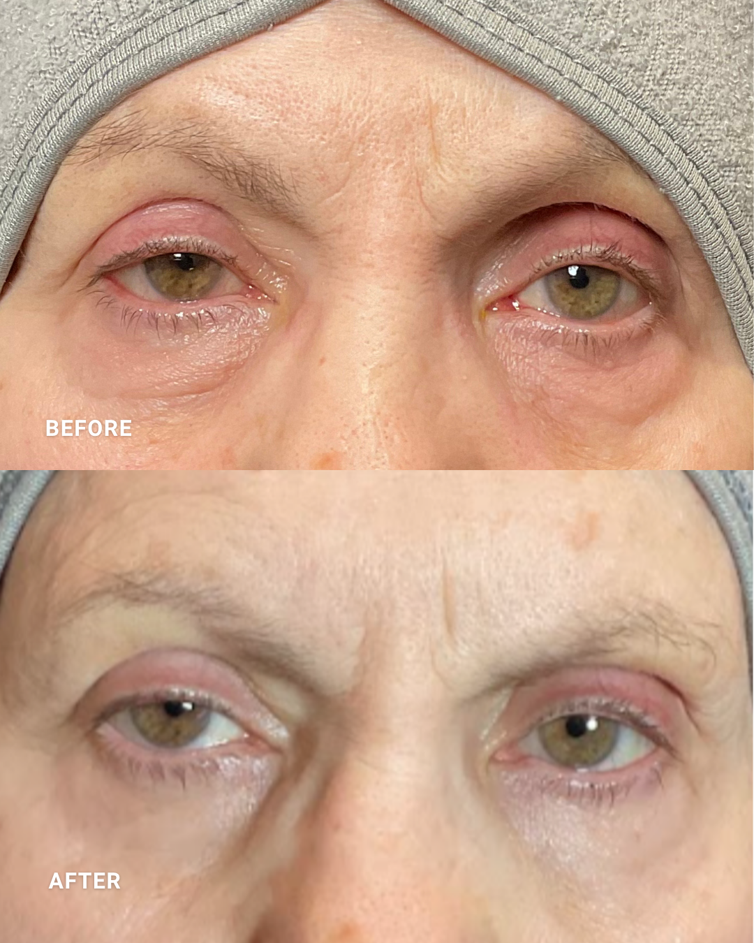 OcuLift | POST 4 TREATMENTS

*Individual results may vary.