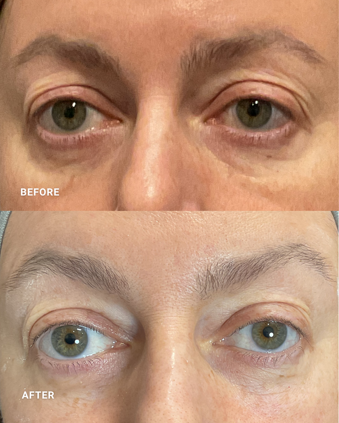 OcuLift | POST 7 TREATMENTS

*Individual results may vary.