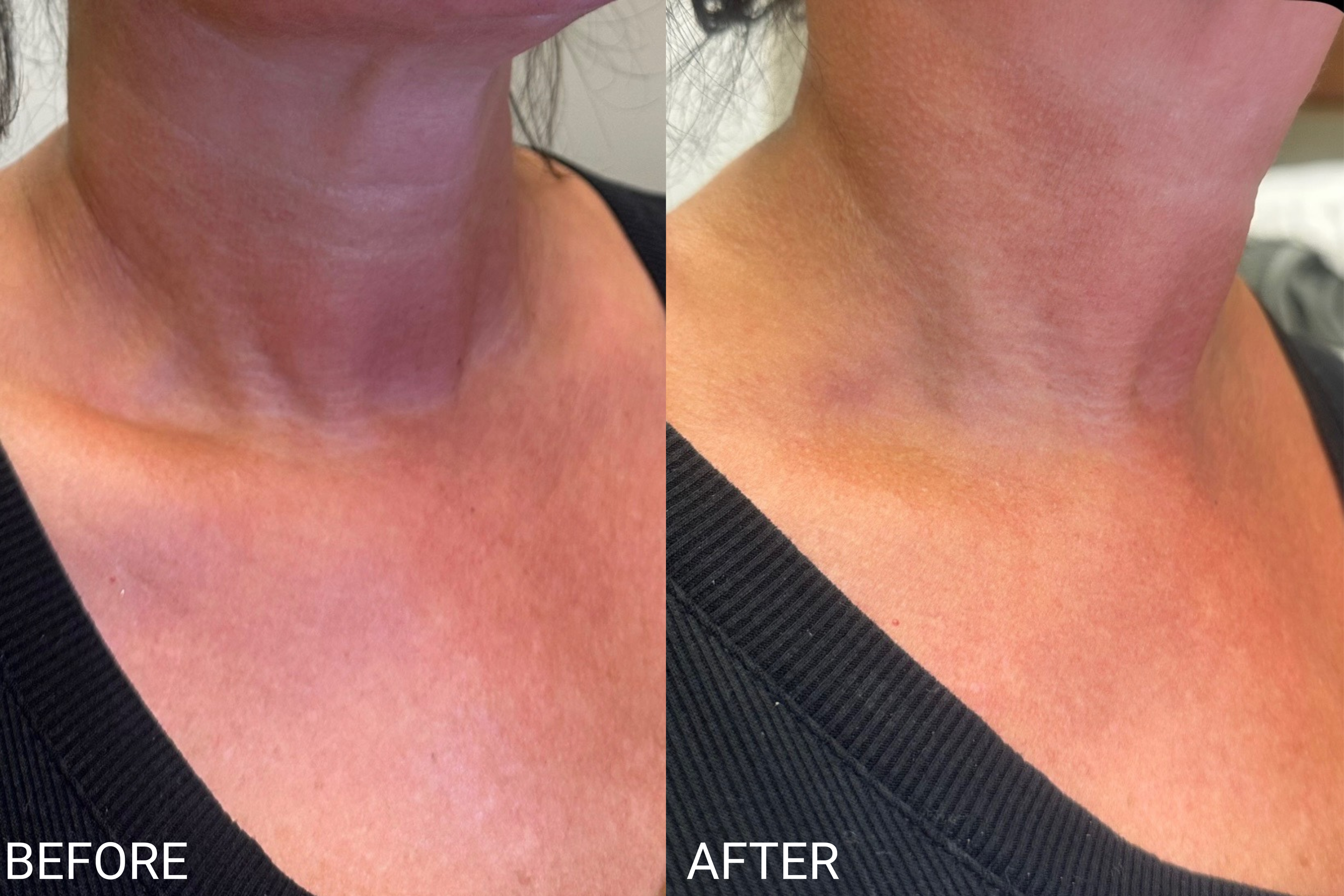 Close-up of a woman's neck and collarbone area showing before and after improvement in skin condition. The 'before' side has dry, rough, and uneven skin, while the 'after' side shows smoother, more hydrated skin with a more even tone.