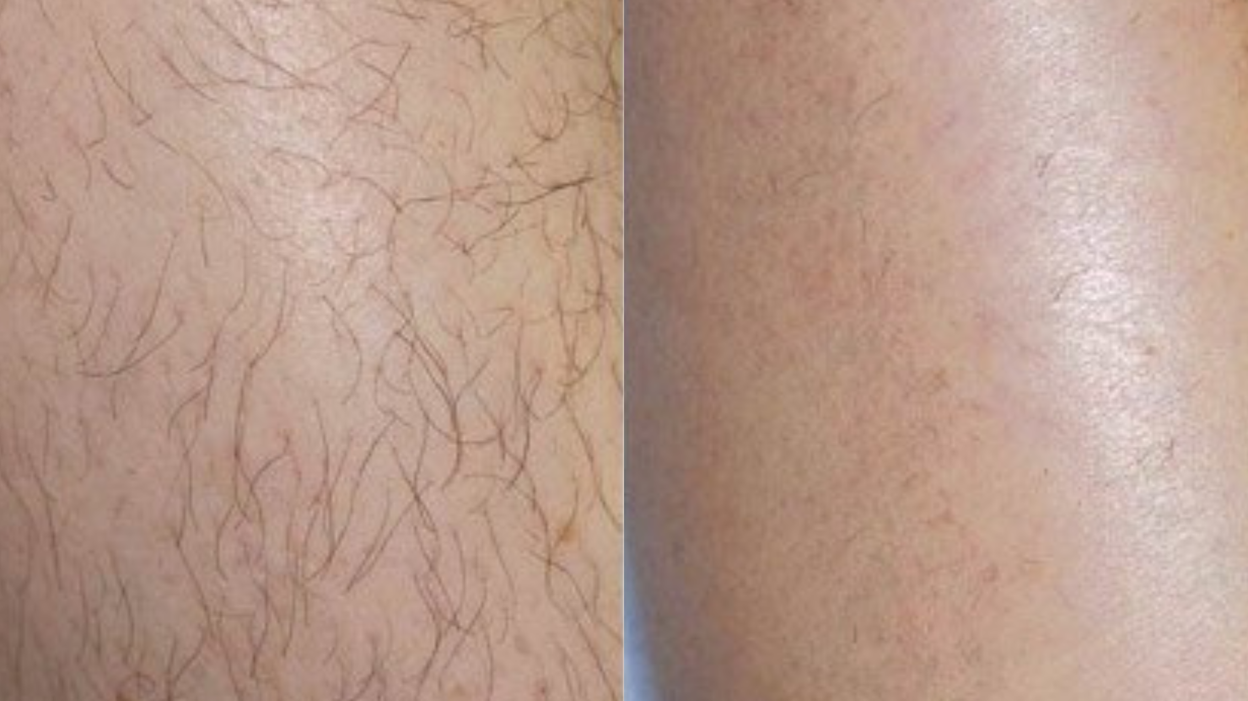Comparison of skin: left side shows skin with visible hair follicles, right side shows smooth, hairless skin.