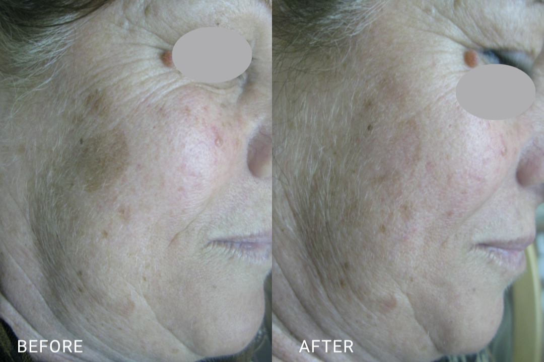 Photo courtesy of Sharona Levi Friedman, Israel. Protocol: Step 1 – Fluence 21.8 J/cm² Single Mode, 1 Pass | Step 2 – Fluence 21.8 J/cm² Single Mode, 1 Pulse over Prominent Spots. Individual results may vary. 