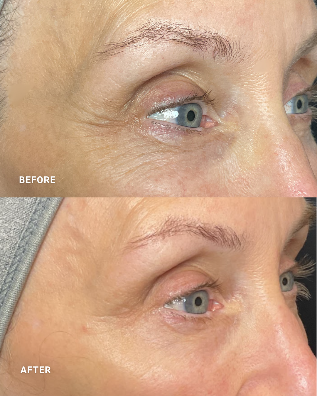 OcuLift | POST 4 TREATMENTS

*Individual results may vary.