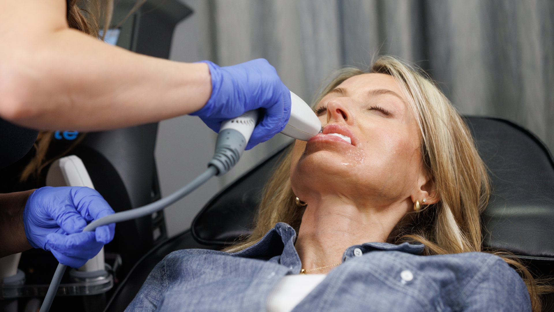 micro-focused RF treatment on lips of female