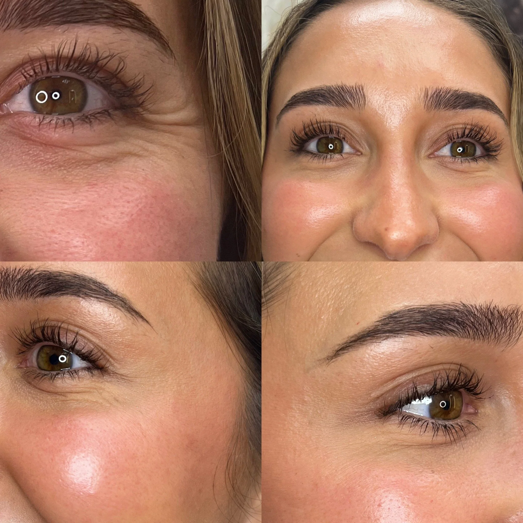 Crows Feet & Brow Lift Botox