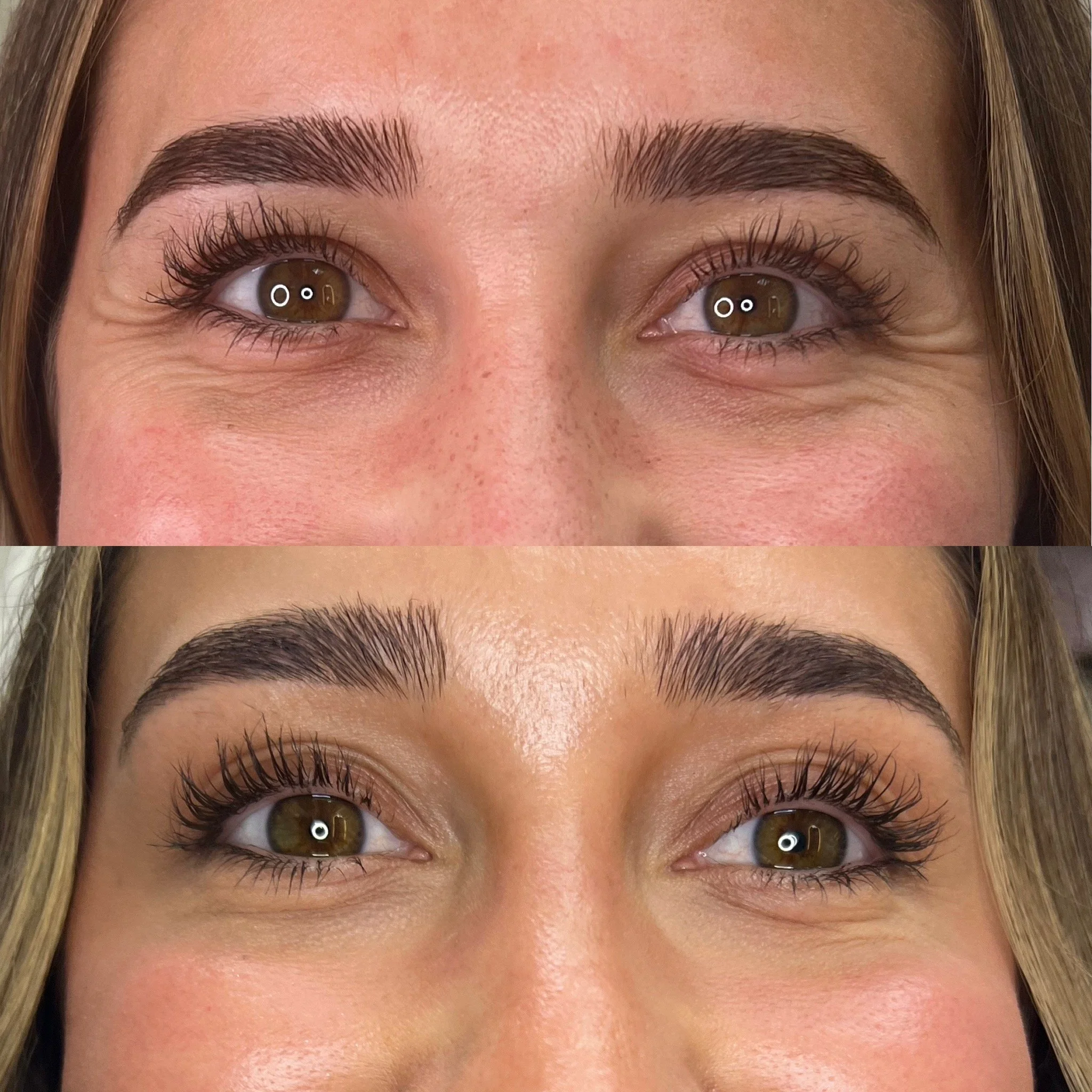 Crows Feet Botox