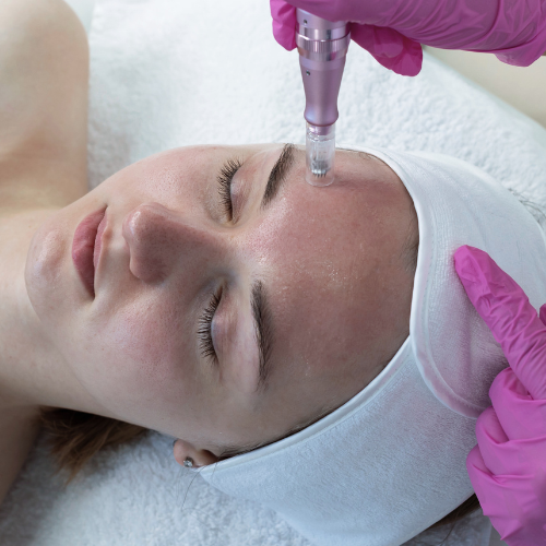 woman having microneedling on face