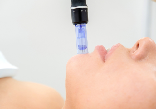 closeup of microneedle pen on chin