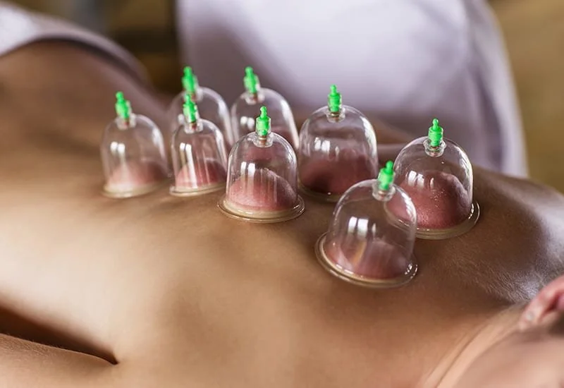 Cupping Technique on Back