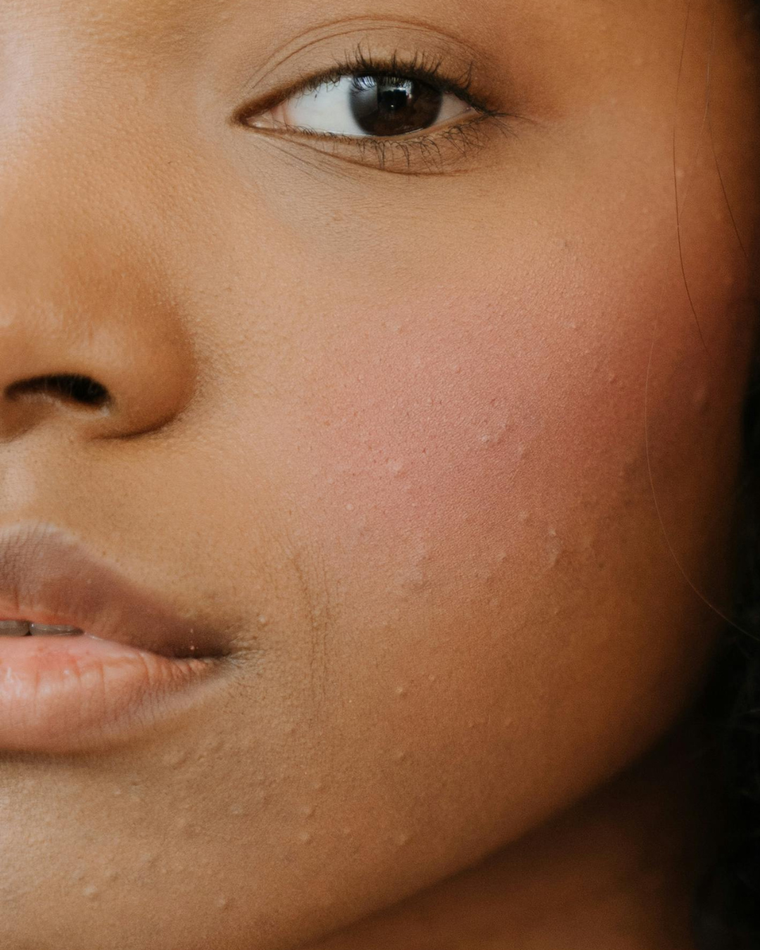 The Ecology of Skin: Fungal Acne, the Microbiome and the Role of Skincare
