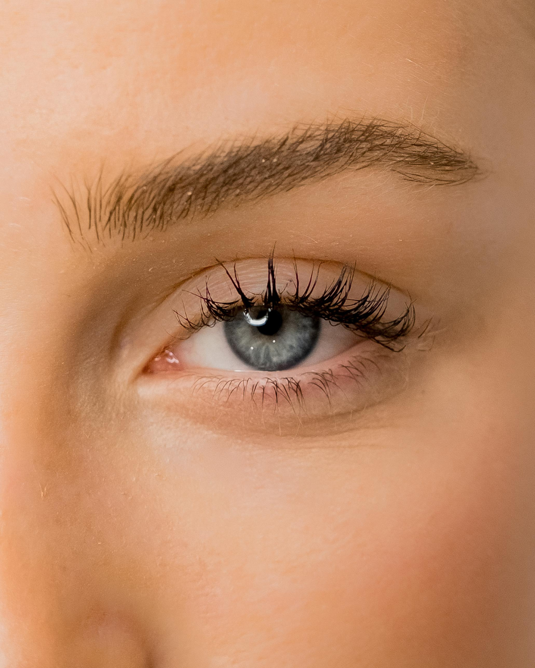 REMOÇÃO DE MICROPIGMENTAÇÃO + REMOÇÃO QUÍMICA - 26 DE JANEIRO