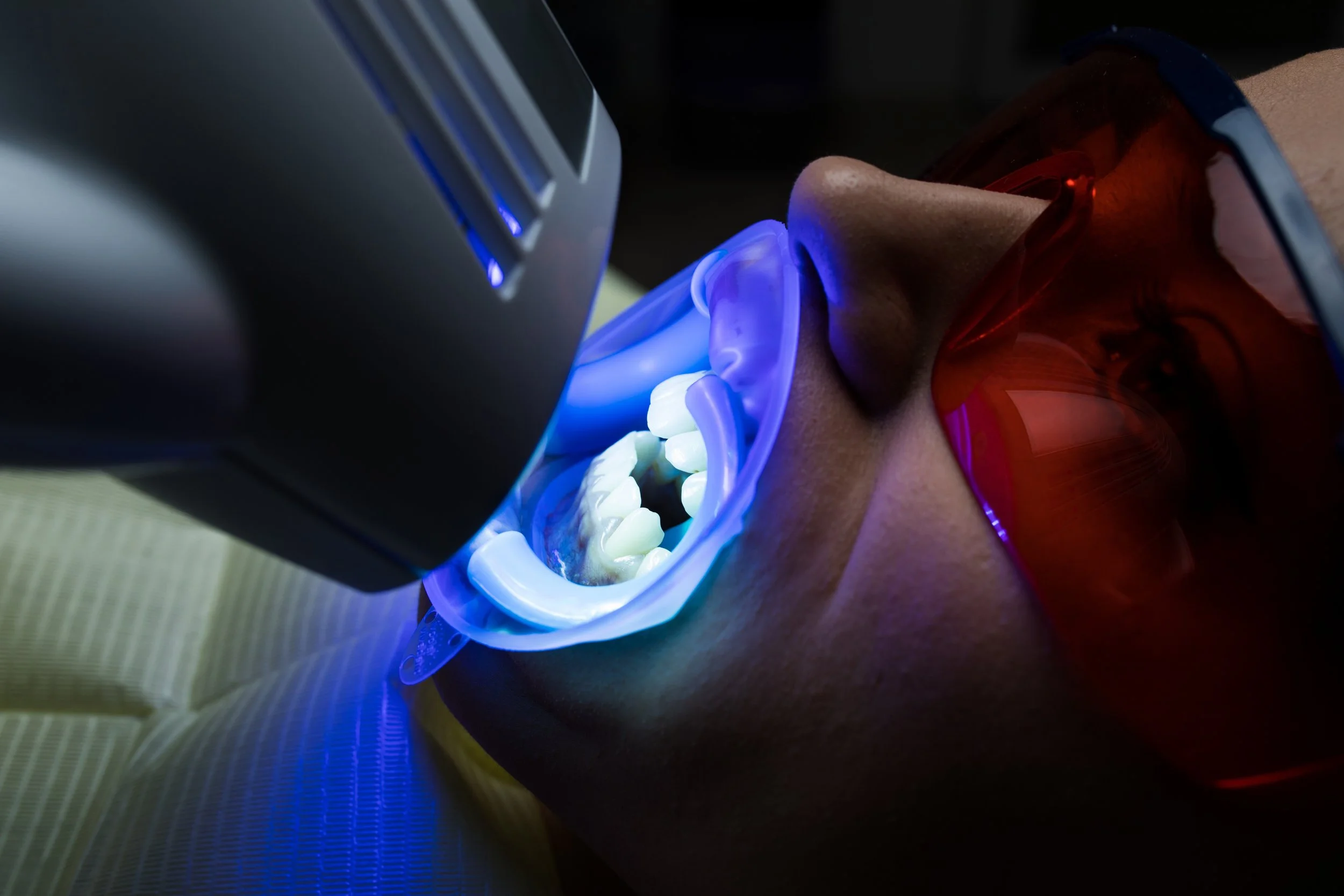 Person undergoing teeth whitening procedure with LED light and red protective glasses lying on a dental chair.