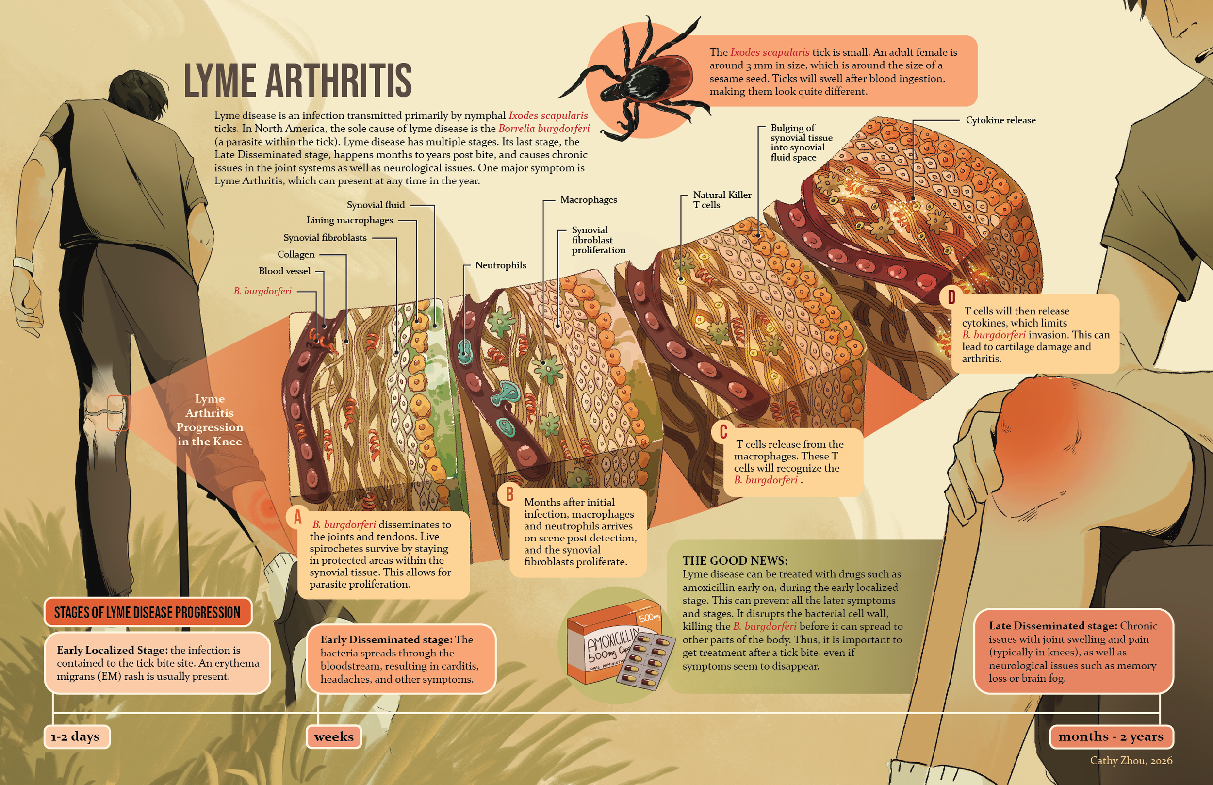 Lyme Arthritis