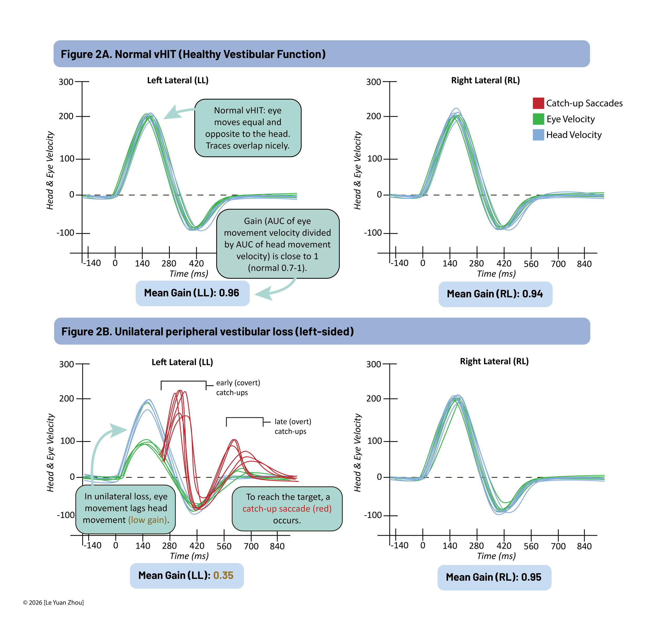Graph showing normal and unilateral peripheral vestibular loss with eye and head velocity over time in milliseconds, with annotations explaining eye movement lag and catch-up saccades.