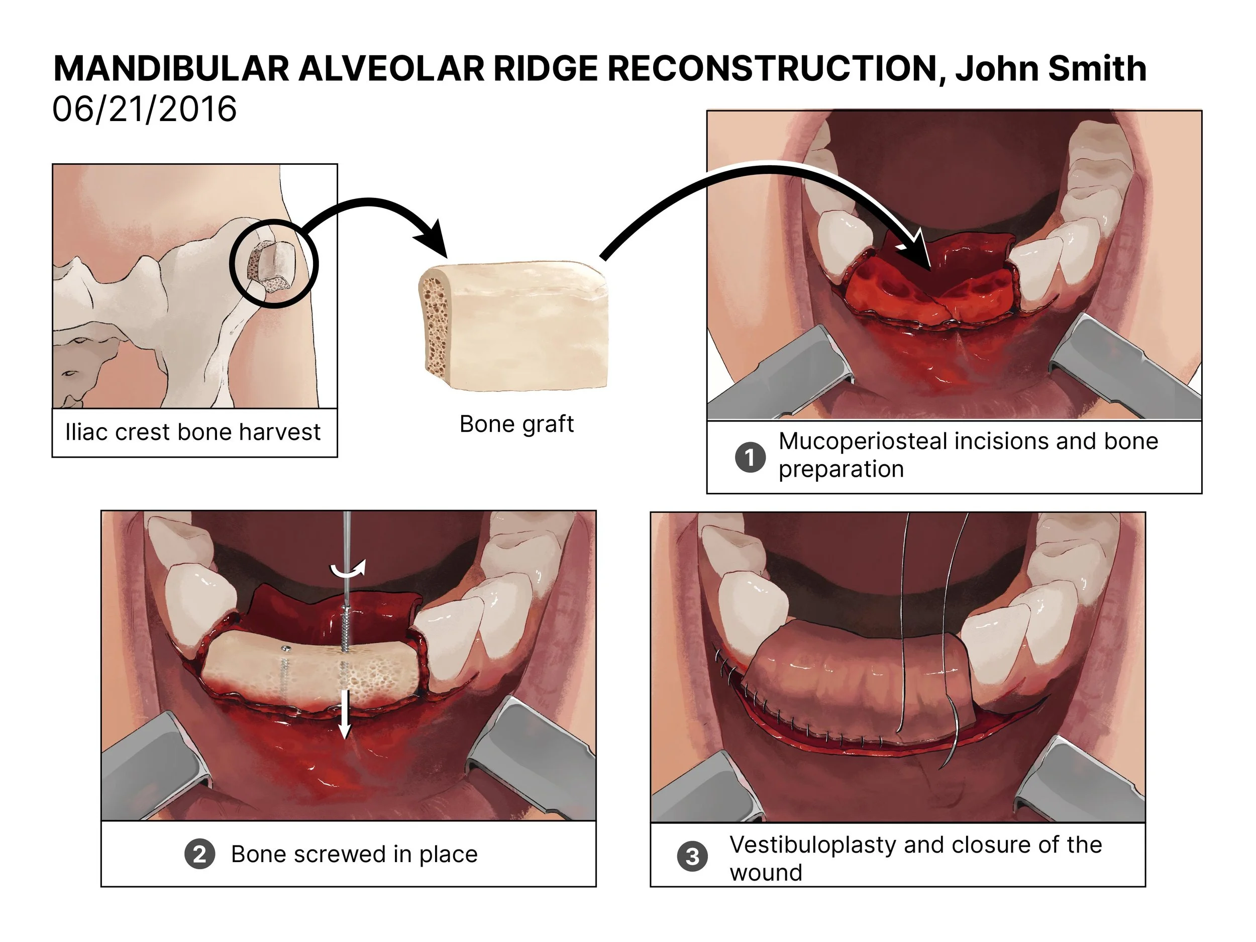 Diagrams showing stages of mandibular alveolar ridge reconstruction, including iliac crest bone harvest, bone graft placement, and wound closure with vicryloplasty.