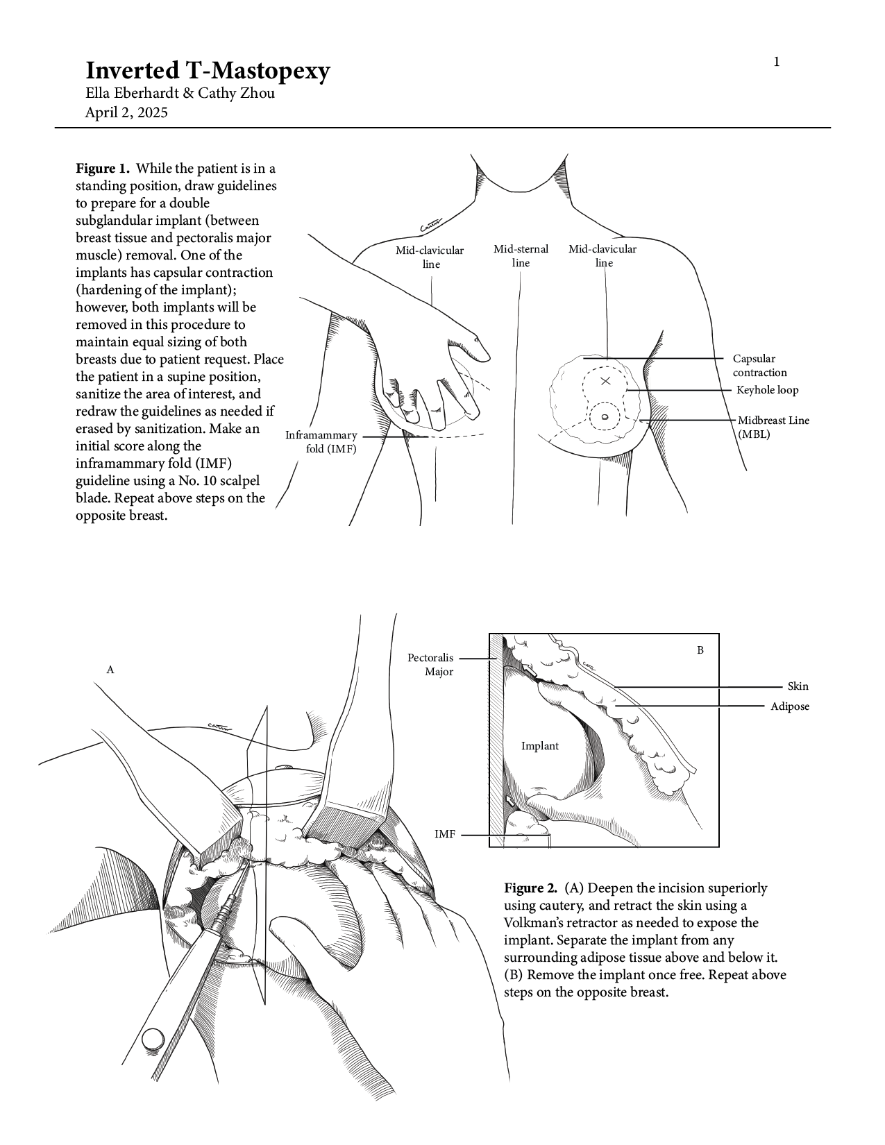 Diagram showing surgical procedure steps for breast implant removal and reconstruction, including guidelines for patient positioning, incision, and implant separation from surrounding tissue.