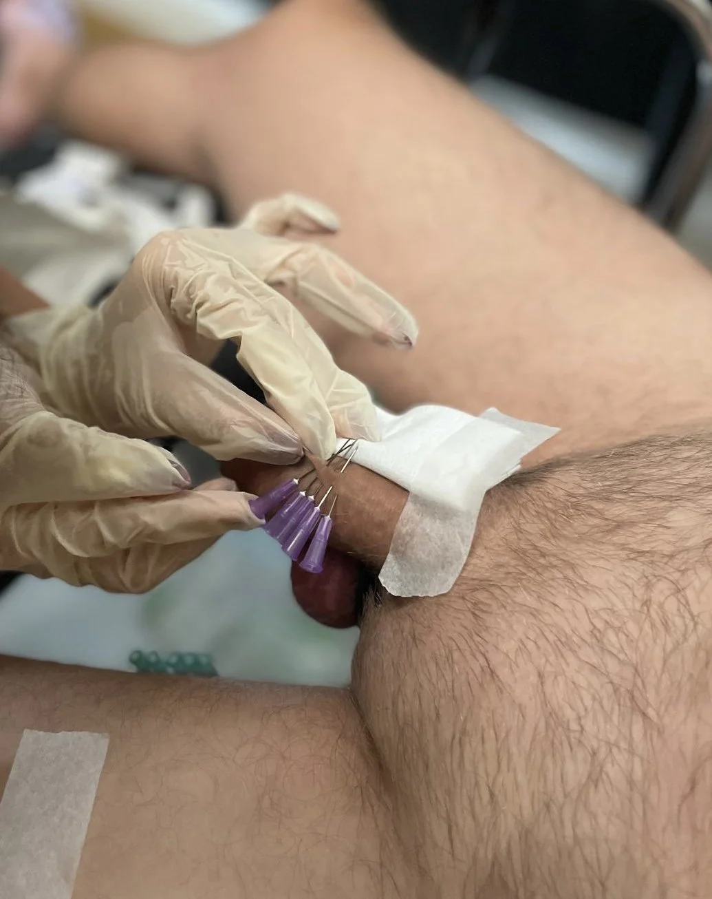 A person wearing latex gloves is performing a medical procedure on a patient's genital area, involving a small injection or sample collection, with the patient lying on their back.