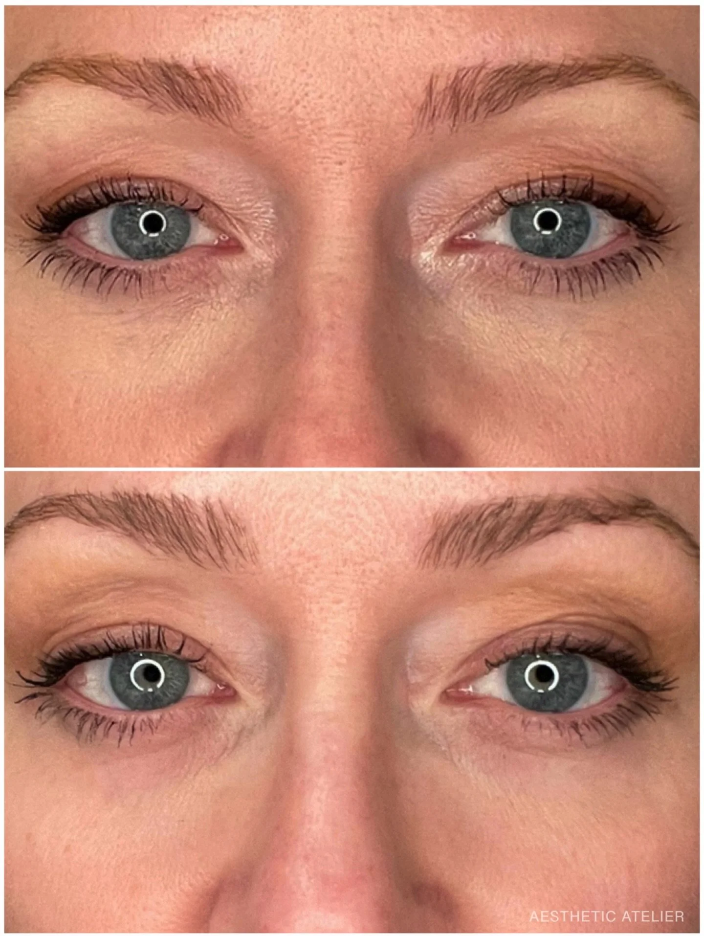 ✨ Non-Surgical Blepharoplasty ✨ results loading&hellip; 
UltraClear&reg; Laser + CORING&trade; + 3D Miracl

Just under 4 weeks post-treatment&hellip; this is only the beginning. @ultraclearlaser keeps tightening and remodeling the eyelids + full face