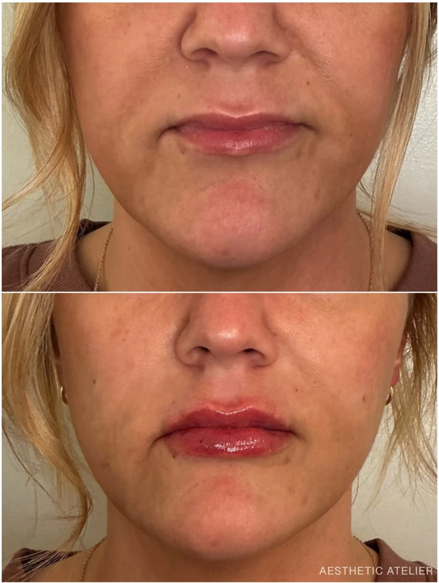 A little RHA magic ✨ a hyaluronic acid filler designed to look and feel purely you&mdash; 
We softened her nasolabial folds and added subtle volume + definition to the lips using RHA for a refreshed, natural result.
Always tailored, always soft, alwa