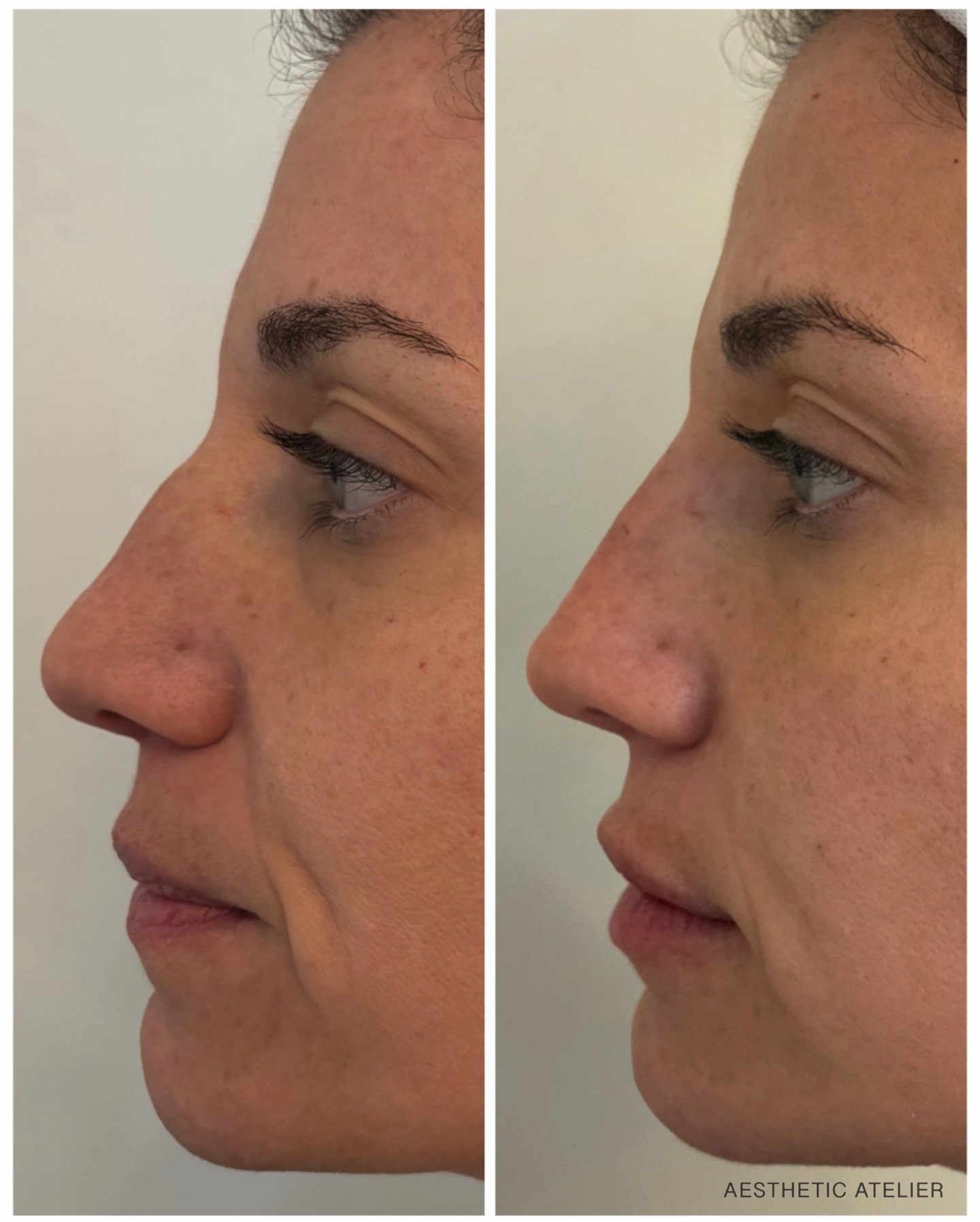 Holiday glow-up ✨

Strategic, natural enhancement using the RHA Collection &mdash; starring favorites RHA4 + Redensity.

&bull; Liquid rhinoplasty
&bull; Mid and lower face rejuvenation + chin support with RHA4
&bull; Subtle hydrating lip plump with 