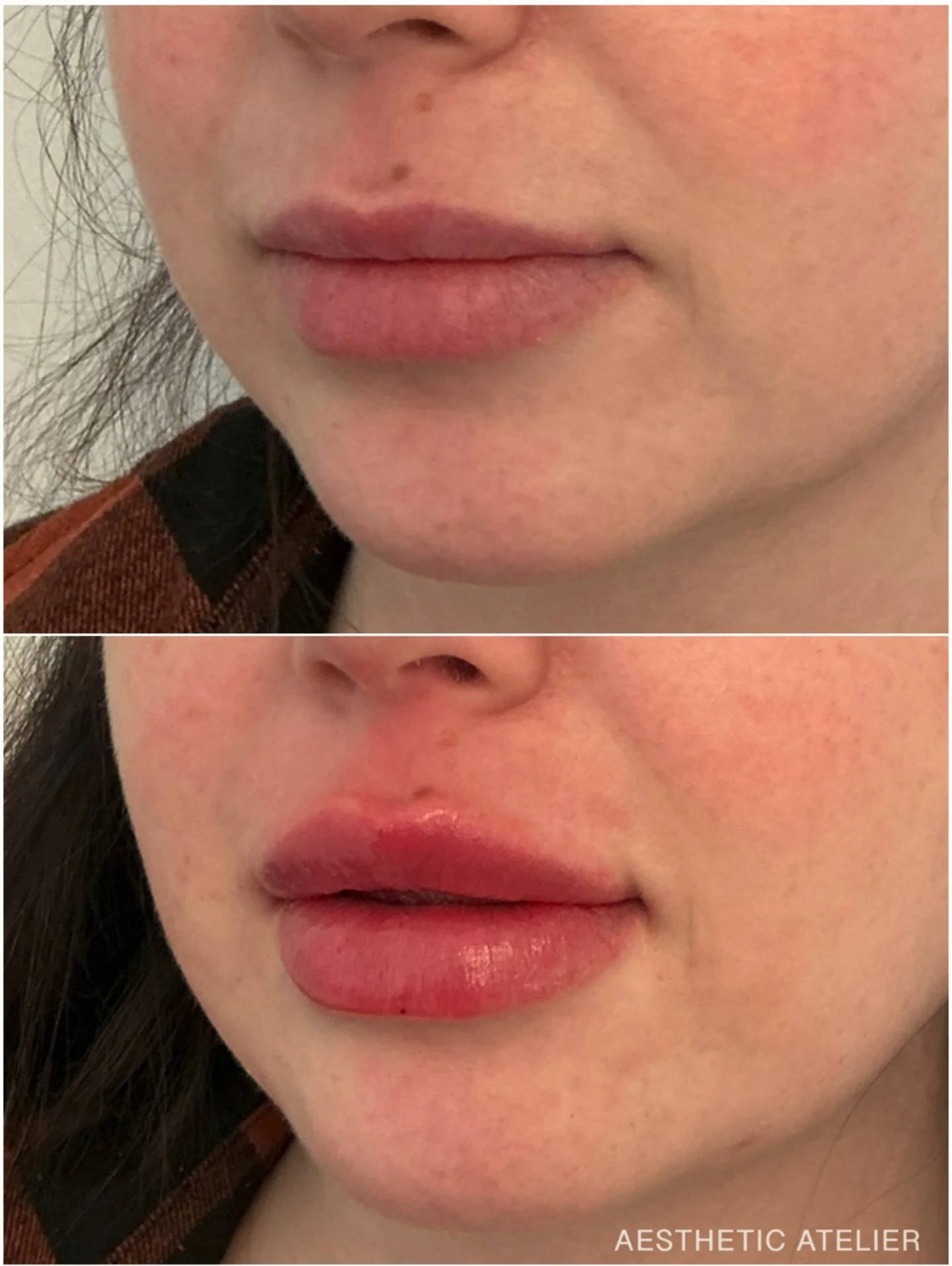 A little refresh for the year ahead - the RHA collection brings soft, intentional balance to this lip enhancement 👄 

Booking confidence @aestheticatelier_medspa 
☎️ 248-573-7009
💻aestheticatelier.co
📱 aestheticatelier@icloud.com