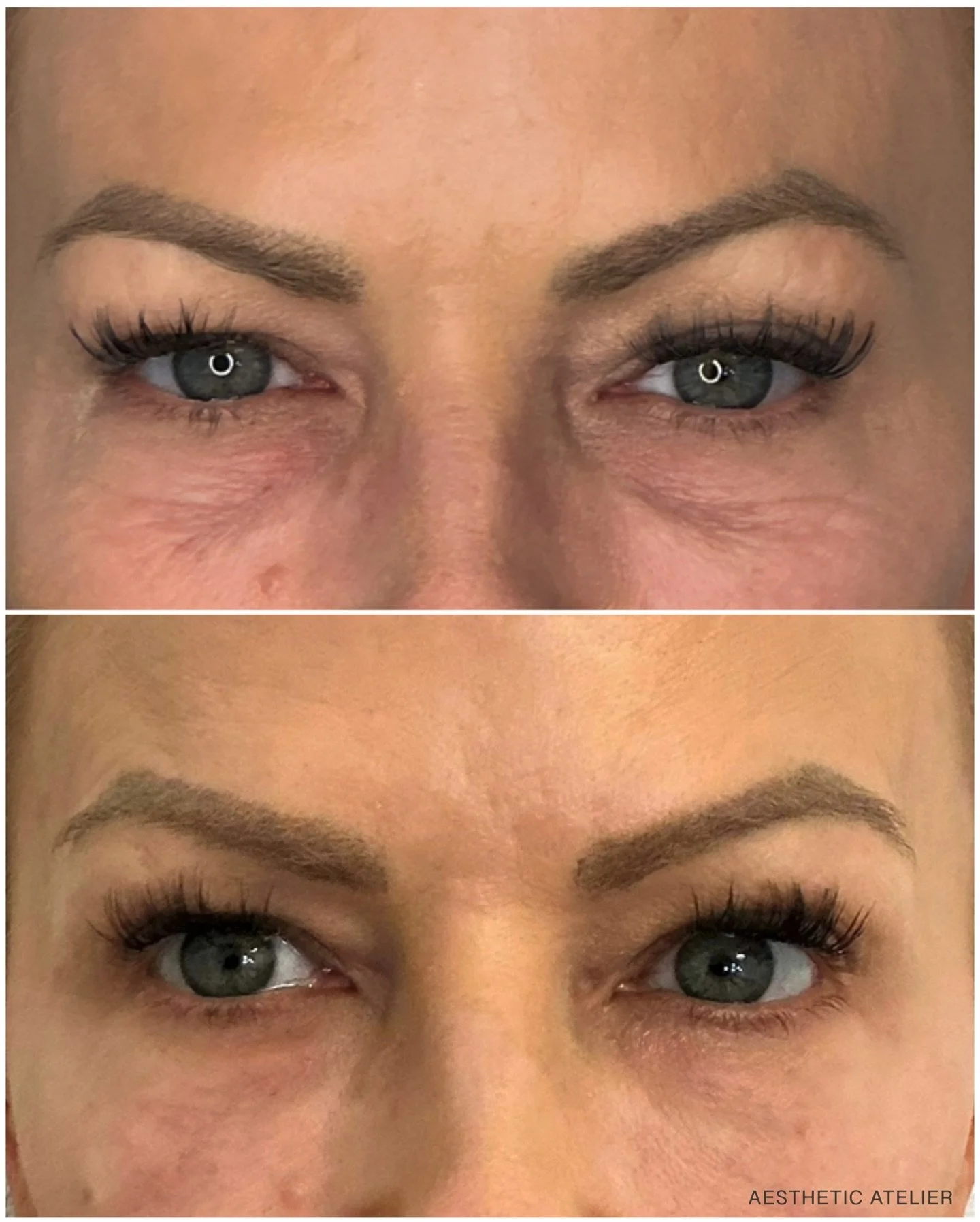 This is what thoughtful undereye rejuvenation looks like.

Two sessions using the magic of growth factor to support collagen and improve skin quality.
Notice brighter, more open eyes as well- achieved with careful, precise Daxxify placement.

No tear