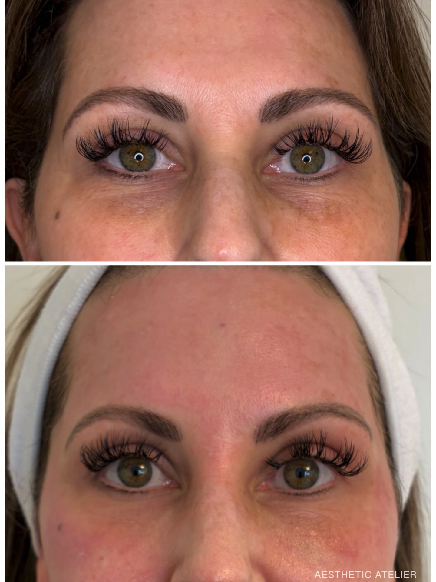 You asked about downtime&hellip;

This is immediately after a #3DMIRACL treatment.

A little pink.
No social hiding.
Right back to real life.

Also pictured: under-eye rejuvenation with @teoxanerhacollection_usa Redensity(and tox!) performed in the s