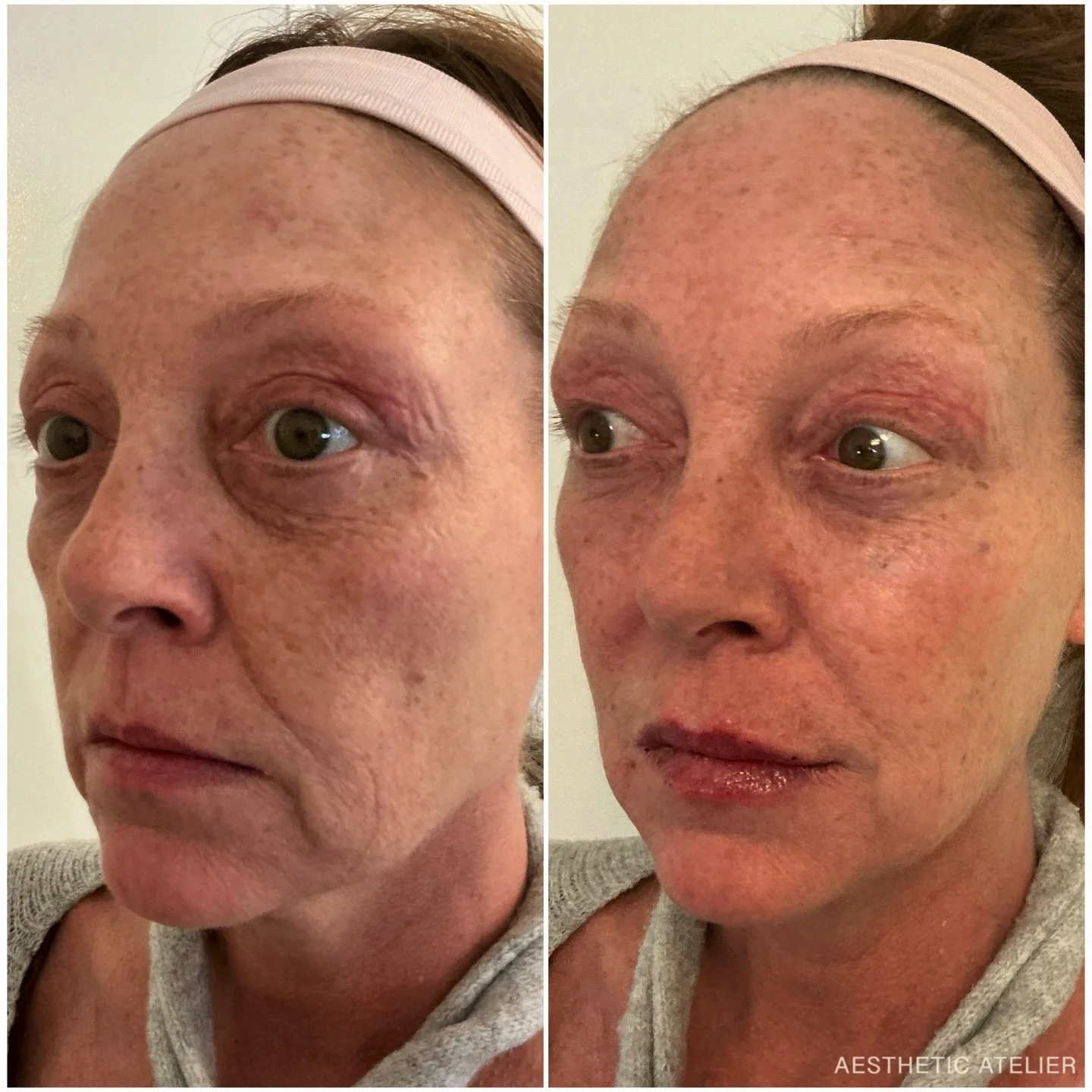 🎨RHA Collection

Featuring favorites: Redensity + RHA4
(with a little RHA2 love in the lips 👄)

This glow will only get better as the hyaluronic acid filler continues to soften and settle beautifully over the next couple of weeks&mdash;
and Daxxify