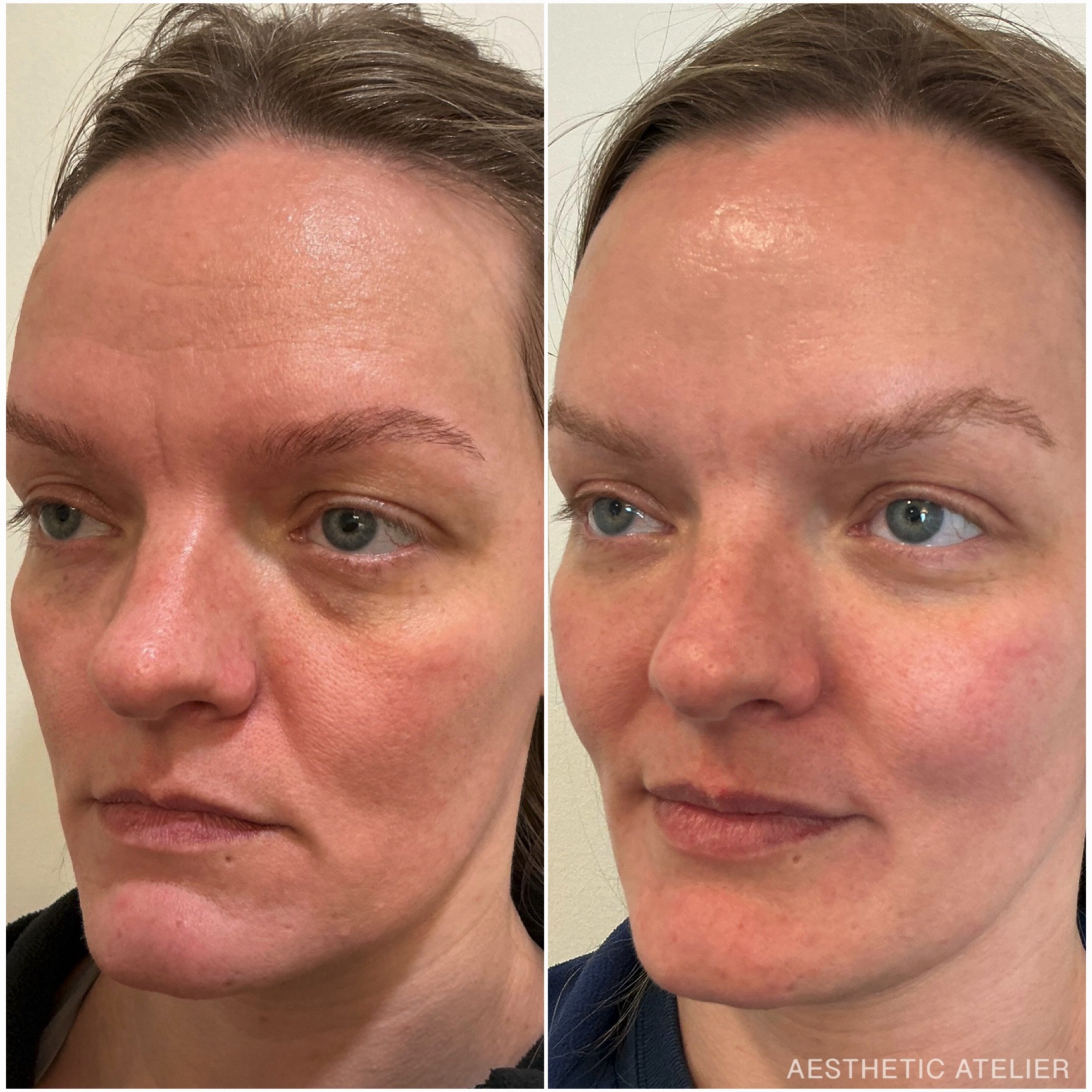 No one&rsquo;s going to ask what you did&hellip; they&rsquo;ll just think you look really good.

This is what we mean when we say:
the best injectable is undetectable.

Just subtle refinement and natural results.

Shown here: 
Before + after (photos 