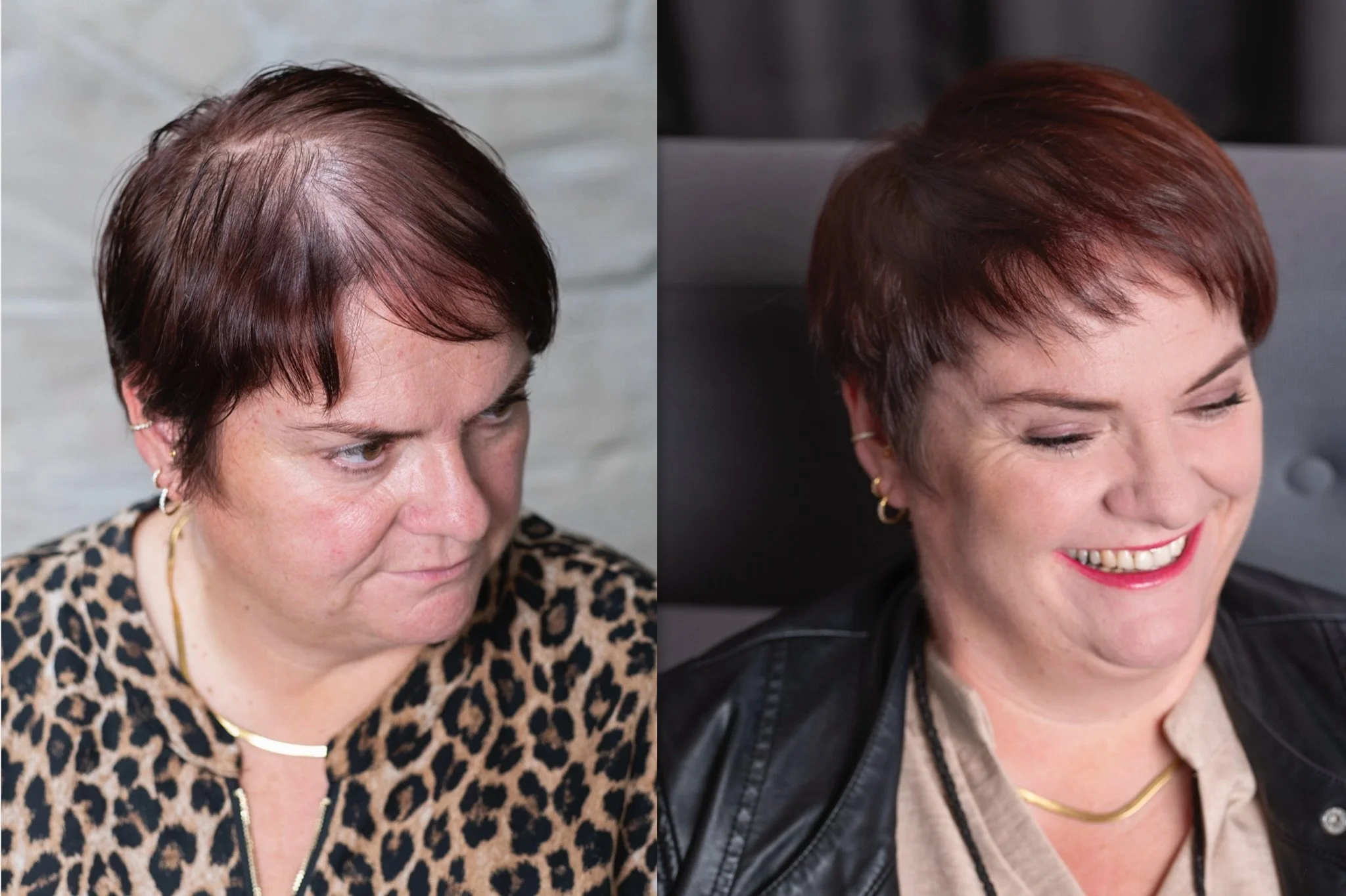 Vorher-Nachher-Aufnahme einer Person mit genetisch bedingtem Haarausfall, links ausgedünnter Scheitelbereich, rechts optisch dichtere Haarstruktur und definiertere Kontur durch HeadSkin Coloring.