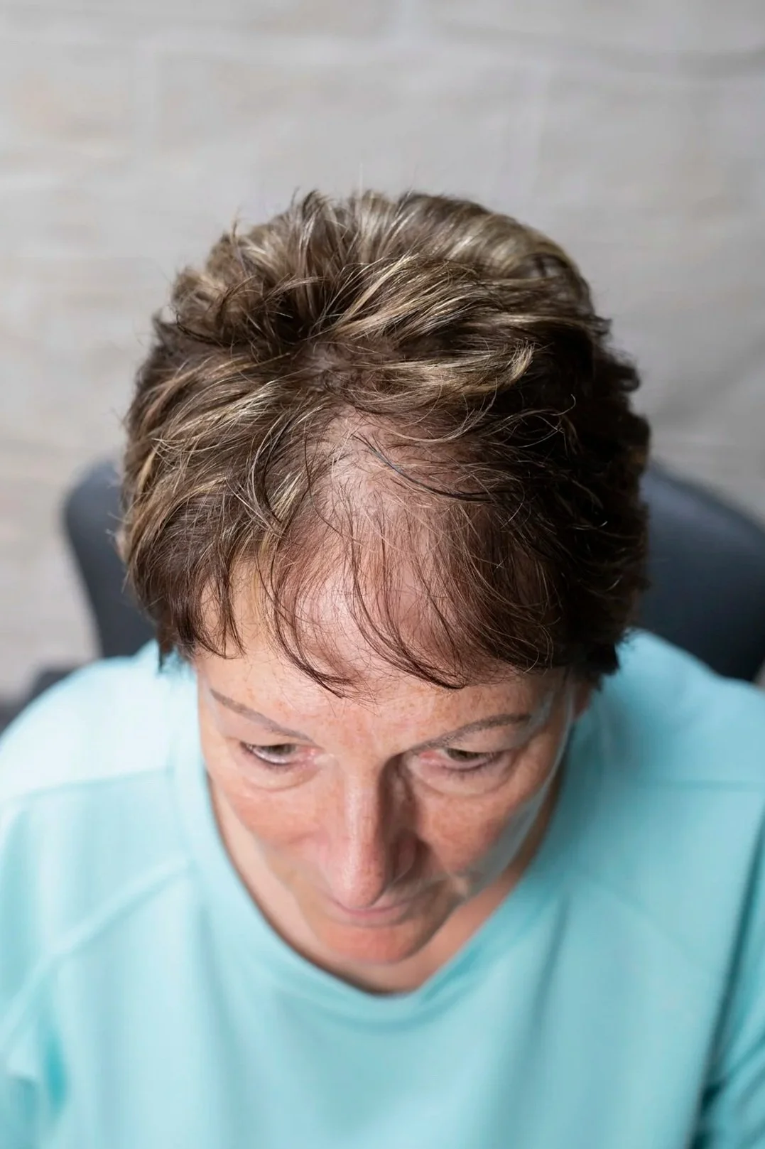 Lichter Scheitel mit sichtbarer Kopfhaut vor HeadSkin Coloring Behandlung zur optischen Haarverdichtung