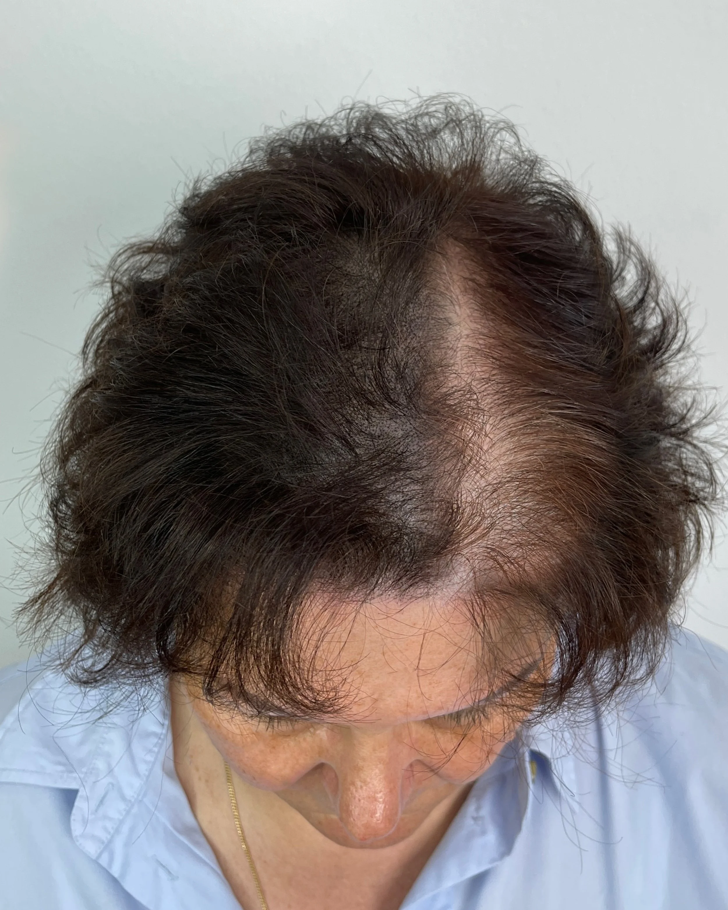 Lichtes Haar am Oberkopf mit sichtbarer Kopfhaut als Ausgangssituation für HeadSkin Coloring zur optischen Haarverdichtung