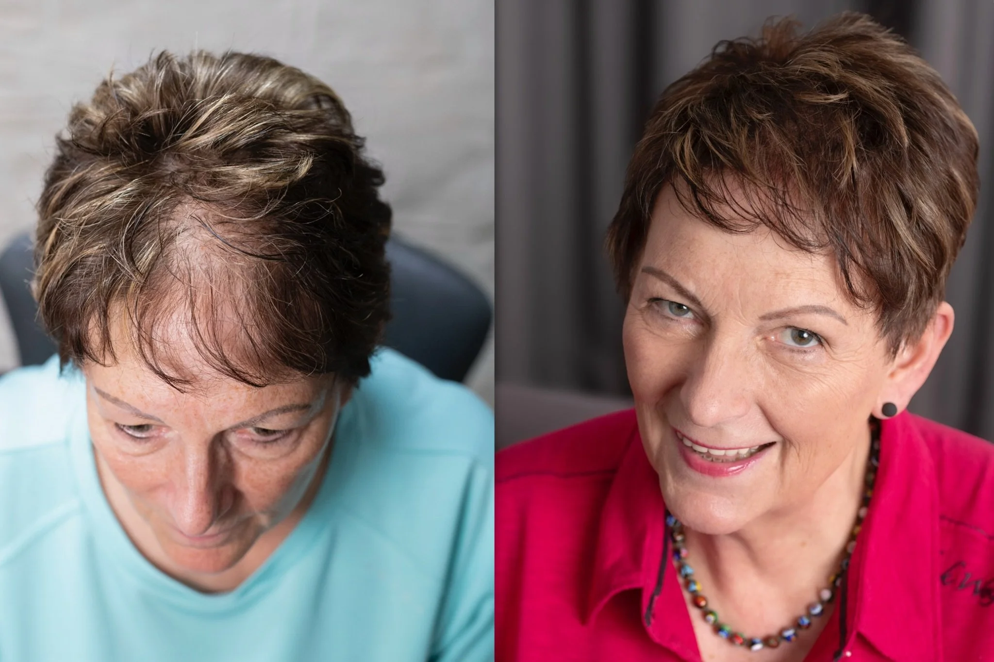 Vorher-Nachher-Foto einer Frau mit hormonell bedingtem Haarausfall am Oberkopf, links helle und sichtbare Kopfhaut, rechts gleichmäßiger und dichter wirkendes Haar durch HeadSkin Coloring.