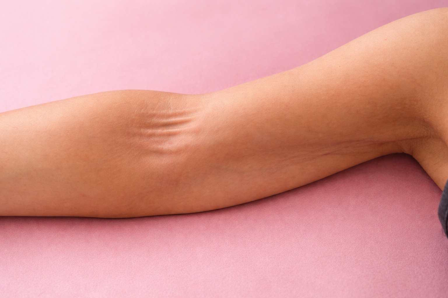 What Is Axillary Web Syndrome (AWS)? Signs, Symptoms &amp; Treatment