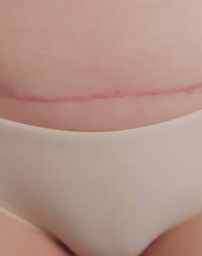 C-Section Scar Mobilization: Why It Matters Years Later