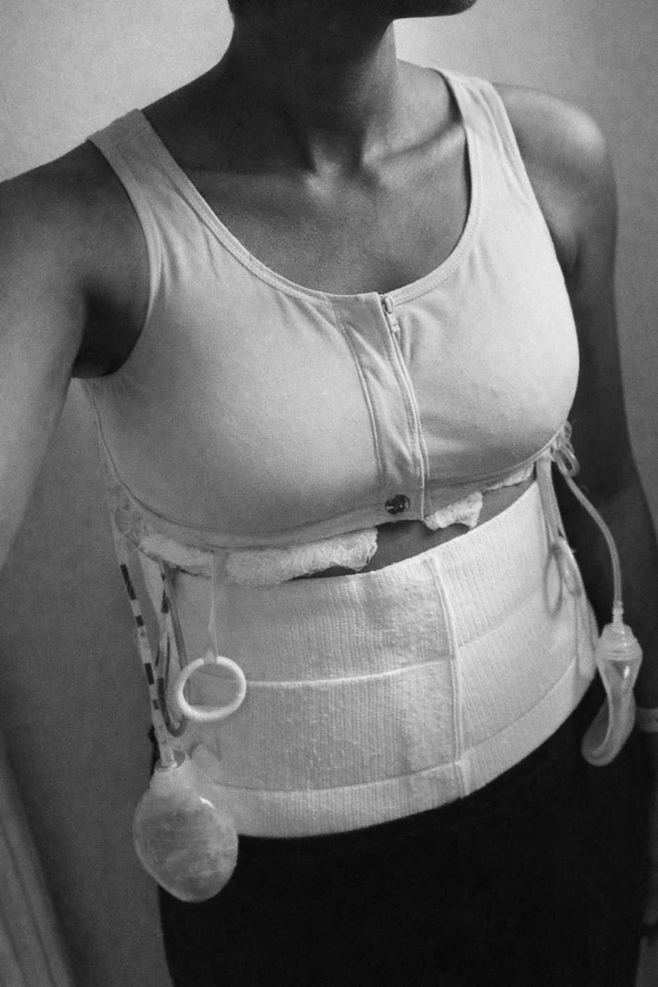 Breast Rehabilitation Should Be Standard After DIEP Flap Reconstruction