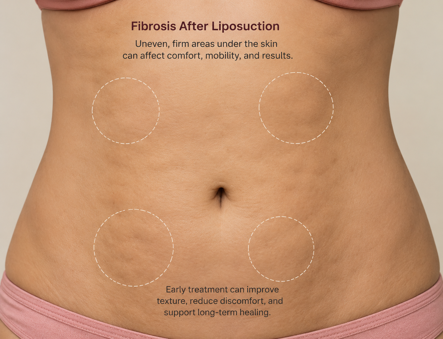 What Is Fibrosis After Liposuction and How Is It Treated?