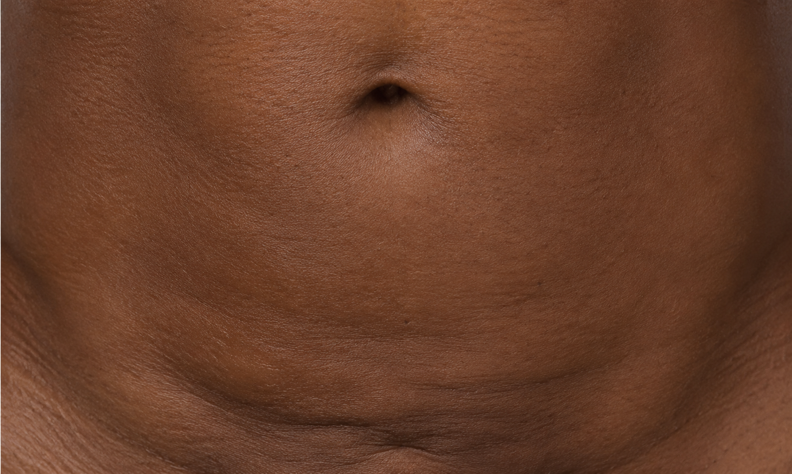 Close-up of abdomen showing lower abdominal swelling consistent with a seroma after liposuction