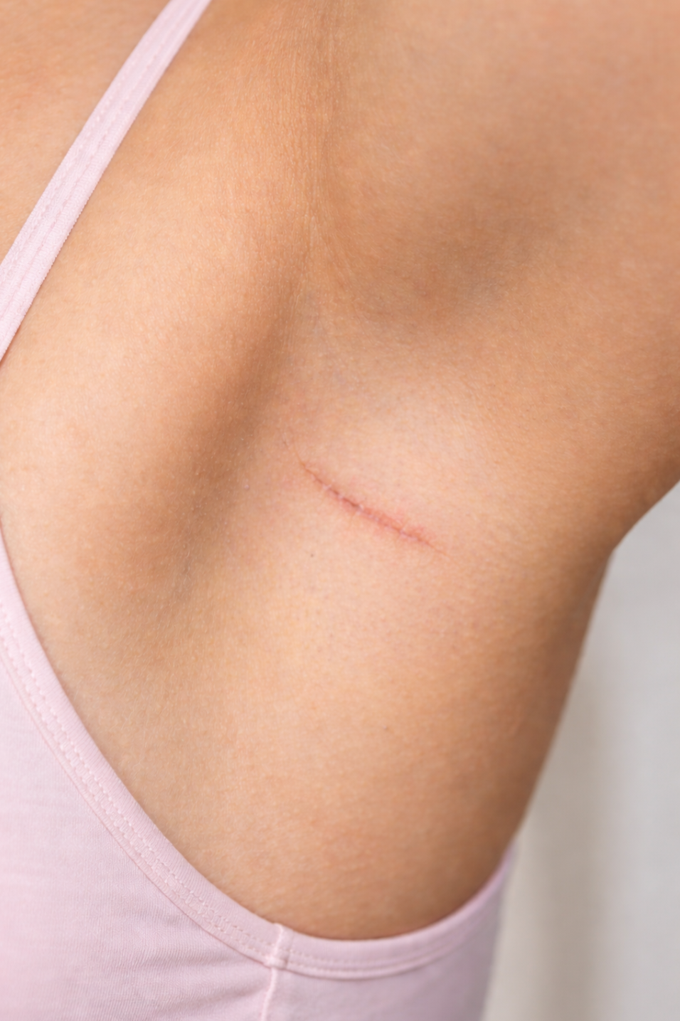 Scar management and prevention therapy after surgery or radiation NYC