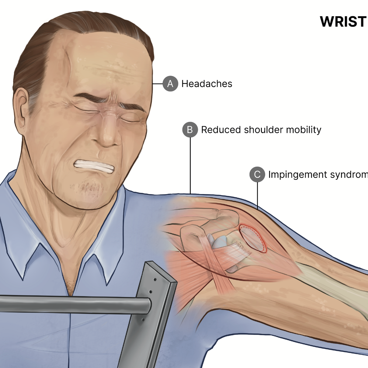 Wrist Fracture Upper Body Complications