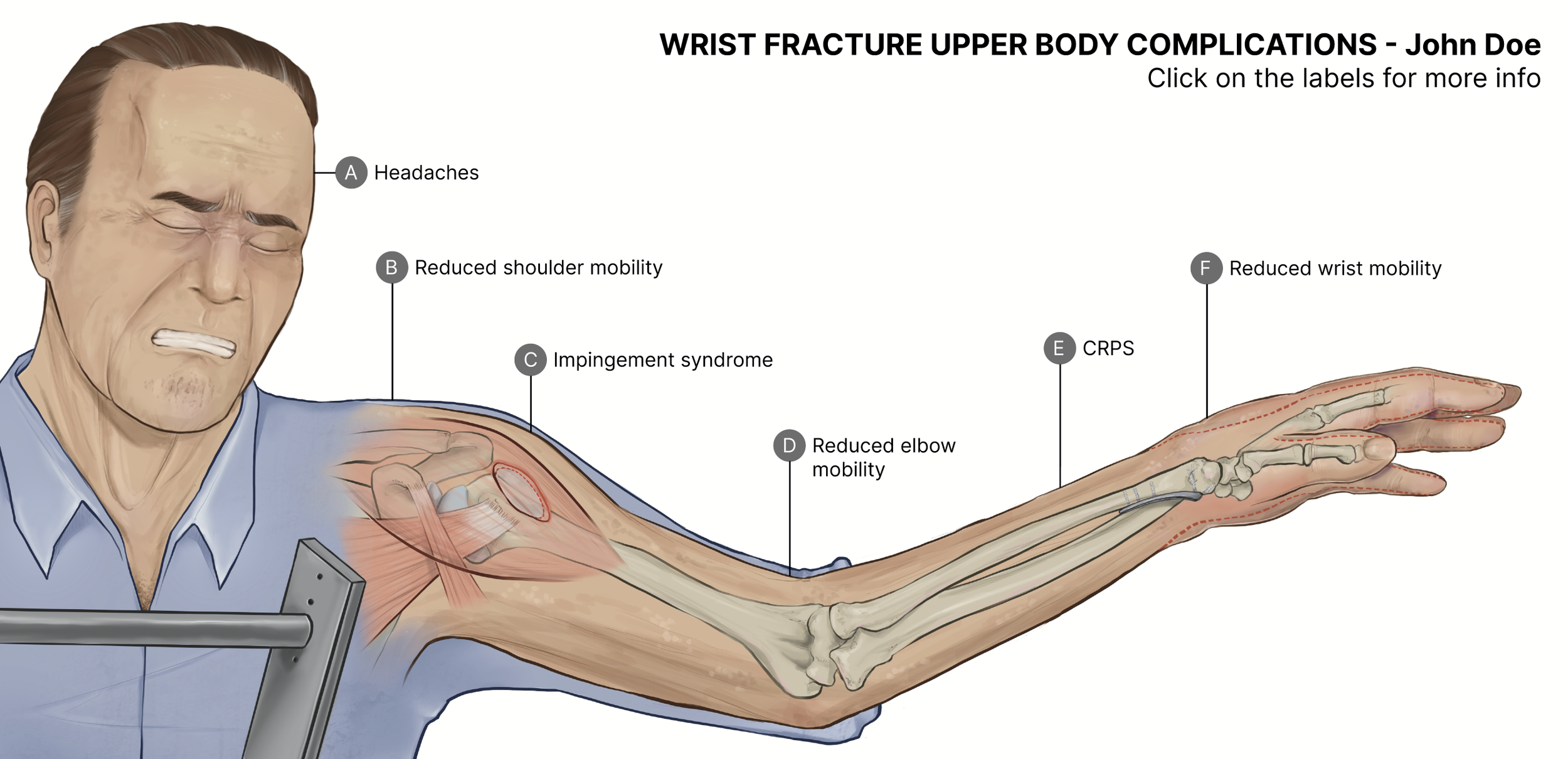 Wrist Fracture Upper Body Complications: John Doe