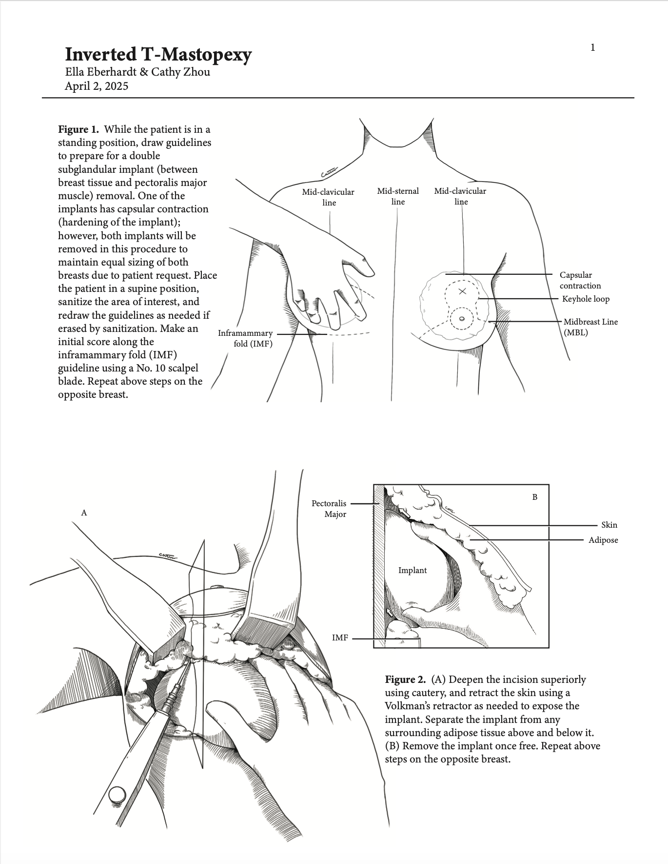 Inverted T-Mastopexy