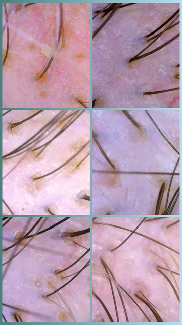 Close-up images of human scalp with hair follicles and hair strands.