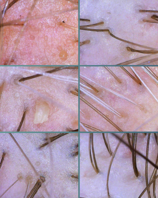 Close-up of skin with hair follicles and some hair removal or skin treatment.
