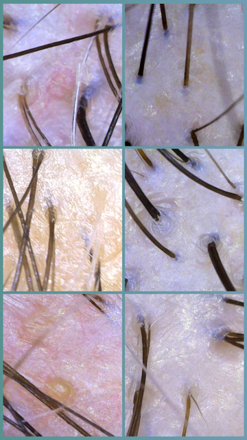 Close-up images of human scalp with hair follicles and hair strands, some with missing or sparse hair.